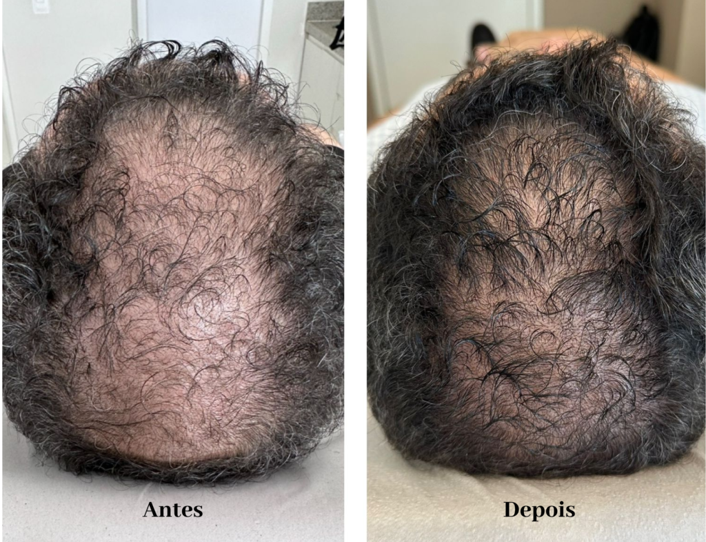 Antes e depois tratamento alopecia através de MMP Capilar.