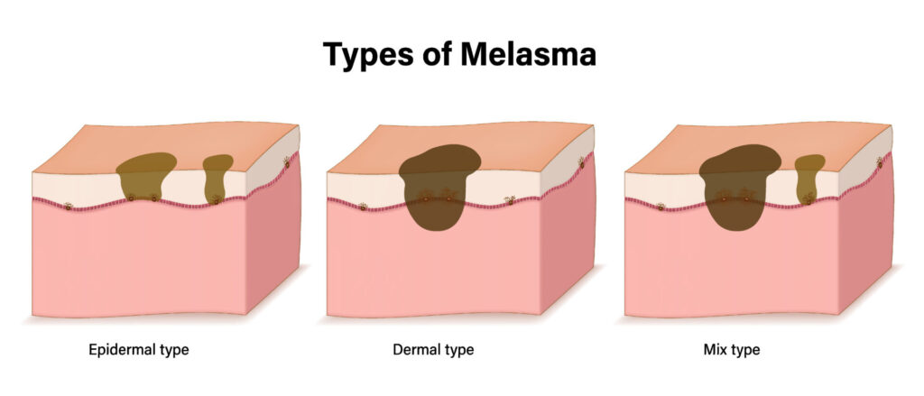 Tipos de melasma. Tratamento para melasma.